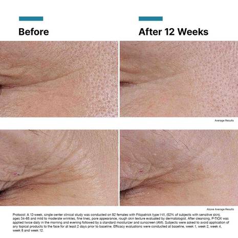 Before and after comparison of skin treatment results on a white background